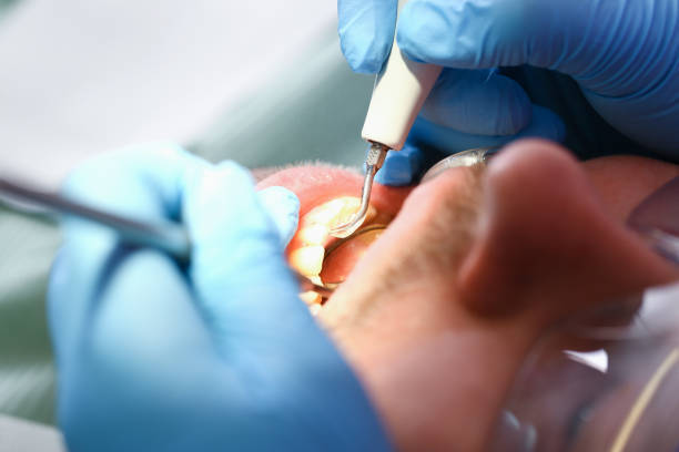 Best Emergency Dental Extractions in James City, NC